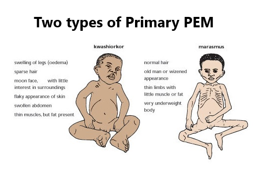 what-are-protein-carbohydrates-deficiency-diseases-tutorix