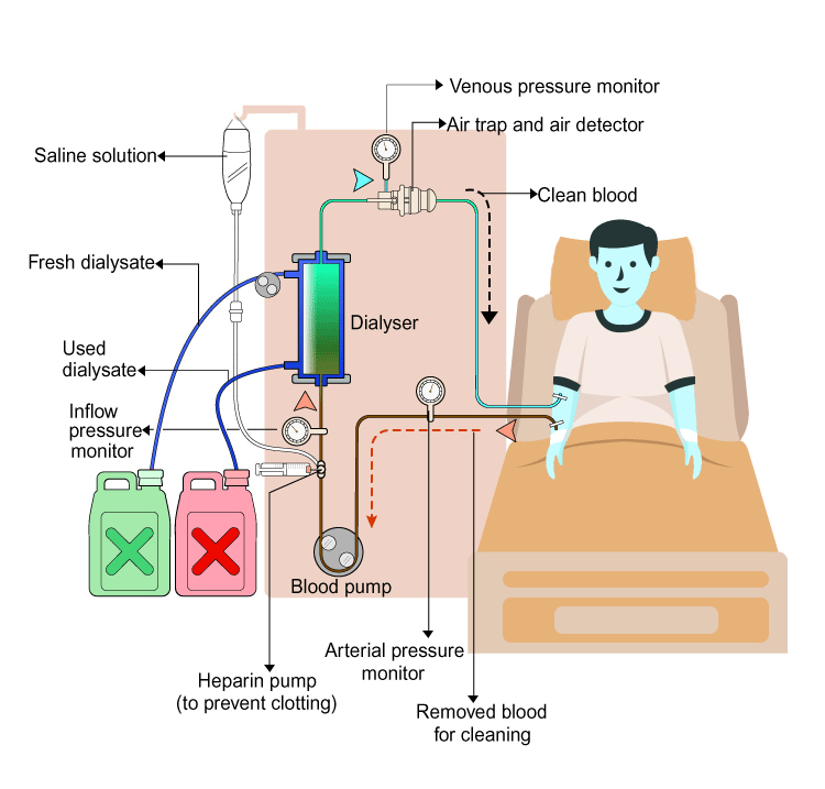 If someone s kidneys are damaged doctors remove wa - Tutorix